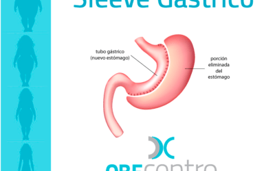 Sleeve Gástrico al detalle