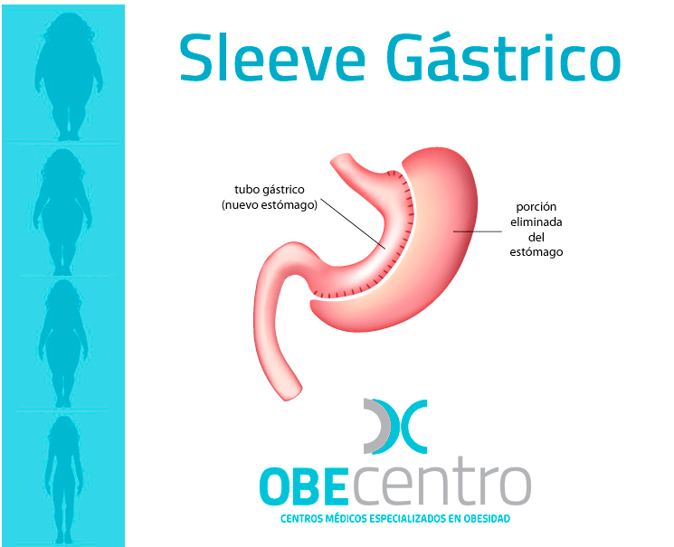 Sleeve Gástrico al detalle