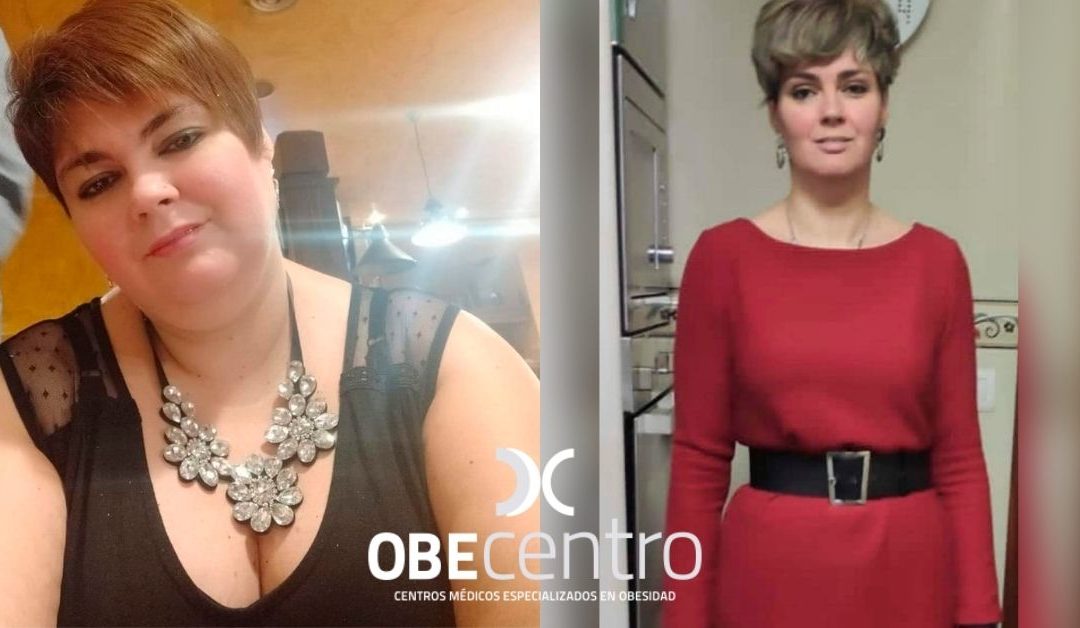 Antes y después del Sleeve Gástrico de Ainhoa